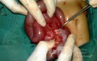 Gangrene Of The Intestine