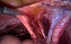 Excision of Pelvic Lymph Nodes