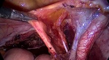 Excision of Pelvic Lymph Nodes