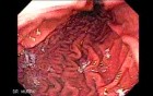 Gastric Folds 1