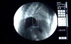 Esophageal Obstruction - Fluoroscopic View