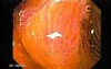 Barrett Esophagus - endoscopic view  (6 of 9)