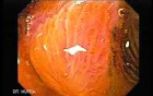 Barrett Esophagus - endoscopic view  (6 of 9)