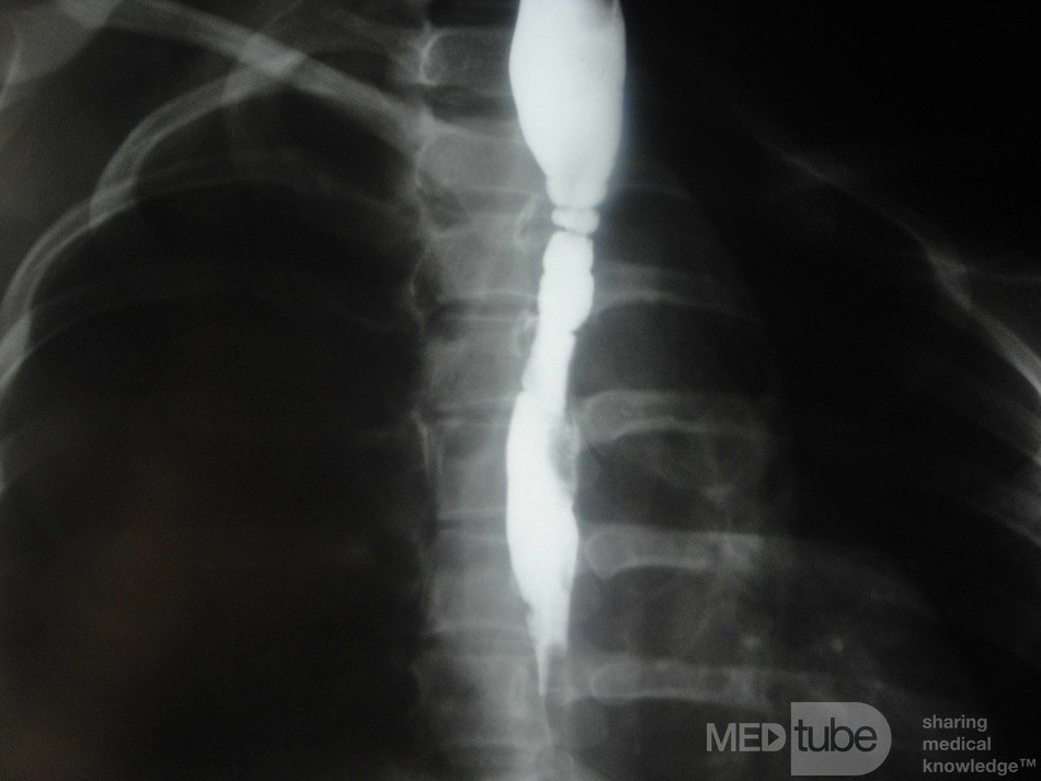 Congenital Esophageal Rings (5 of 5)
