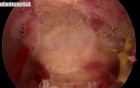 Resection of Patological Septum by Use of Hysteroscopy