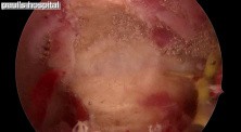 Resection of Patological Septum by Use of Hysteroscopy