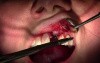 Suturing Technique - Implant Placement #9