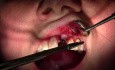 Suturing Technique - Implant Placement #9