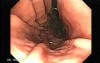 Endoscopy of stomach and duodenum