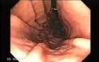 Endoscopy of stomach and duodenum