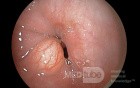 Granular Cell Tumor Of The Distal Esophagus