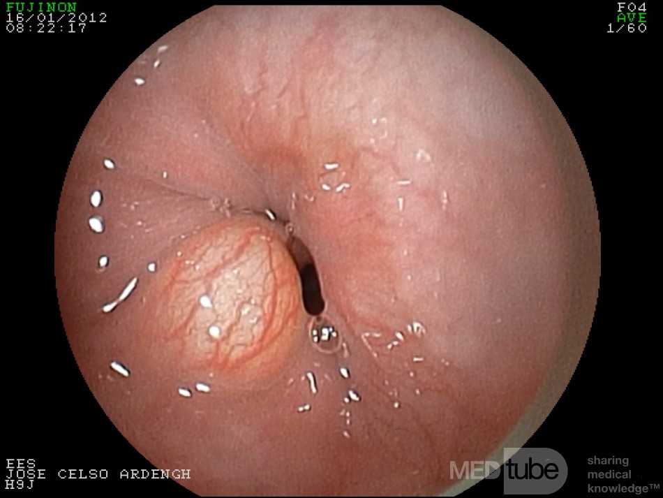 Granular Cell Tumor Of The Distal Esophagus