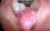 The Sessile-Based True Vocal Fold Polyp-Spontaneous Movements upon Respiration