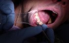 How Do You Increase Attached, Keratinized Gingiva? Tire Patch? Not Here.