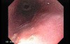 Pill Esophagitis - 3/5