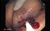 Tubulo - Villous Rectal Adenoma - Endoscopy (6 of 35)