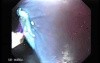 Barrett's Esophagus of long segment (10 of 24)