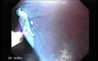 Barrett's Esophagus of long segment (10 of 24)