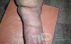 Lymphoedema Of The Lower Limb