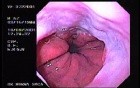 Sliding Hiatal Hernia