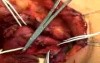 The Carotid Body tumor