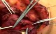 The Carotid Body tumor