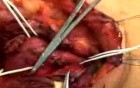 The Carotid Body tumor