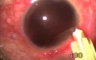 Traumatic blackball hemorrhage management