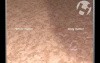 Closed Head Injury - Coup Contrecoup