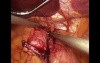 Laparoscopic Banded Gastric Bypass