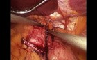 Laparoscopic Banded Gastric Bypass