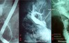 Endoscopic Litotripsy