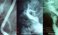 Endoscopic Litotripsy