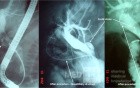 Endoscopic Litotripsy