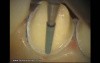 Final Preparation For Aesthetic Veneers (3/4)
