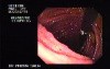 Familial Adenomatous Polyposis of the Colon (6 of 29)