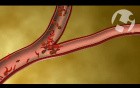 Vessel Obstruction and Sickle Cell Anemia
