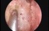 Ear, nose and throat surgery