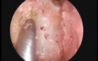 Ear, nose and throat surgery