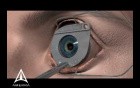 Lasik Surgery - 3D Medical Animation 
