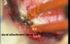 Spinal Cord Tumor - Intra Dural Meningioma - Microsurgery