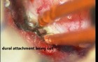 Spinal Cord Tumor - Intra Dural Meningioma - Microsurgery