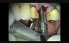 Periodontal Microsurgery: Immediate Maxillary Molar Implant