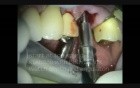 Periodontal Microsurgery: Immediate Maxillary Molar Implant