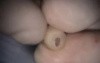 Lower Left Premolar Implant Microsurgery