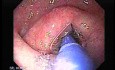 Achalasia - Guidewire For Esophageal Dilation - 3/4