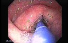 Achalasia - Guidewire For Esophageal Dilation - 3/4