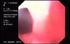 Mallory-Weiss Tear - Quick Assessment of the GE Junction
