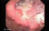 Reflux Esophagitis and Adenocarcinoma of the Antrum (2 of 3)