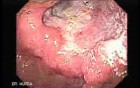 Reflux Esophagitis and Adenocarcinoma of the Antrum (2 of 3)